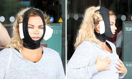 Hãi hùng gương mặt sưng phồng, biến dạng vì ‘dao kéo’ của Katie Price