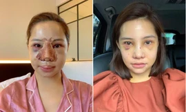 Nữ diễn viên đăng ảnh mặt sưng phồng sau dao kéo. Ảnh: FBNV. 