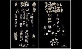 Bộ xương người mẹ ( bên trái) và cặp song sinh,