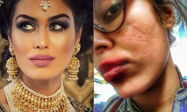 Hoa hậu Anh bị tổn thương mặt vì đeo khẩu trang quá nhiều khi làm bác sĩ chống COVID-19