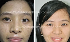 Nhiều bạn trẻ đau khổ vì mụn thịt