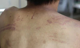 Bé trai bị bố đánh bầm dập hoảng loạn tinh thần