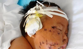 Em bé bị mẹ dùng kéo đâm nát mặt