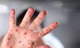 Trên thế giới, hơn 80 trẻ em đã mắc đậu mùa khỉ Ảnh: Healthsite 