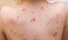 Bệnh đậu mùa khỉ có nguy cơ cao xâm nhập vào Việt Nam 