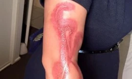 Bị bỏng vì ngủ quên khi dùng iPhone 7 đang cắm sạc