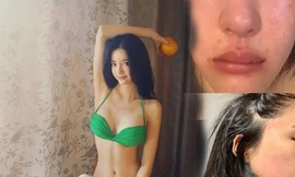 'Bản sao 19 tỷ' của AngelaBaby tố bị CEO bạo hành sưng bầm mặt