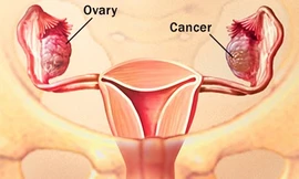 Kết hợp thuốc tăng thời gian sống sau ung thư buồng trứng