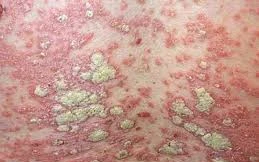 Tìm lại niềm vui sau nhiều năm bị vẩy nến