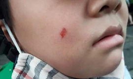 Má em H.G, học sinh trường TH và THCS Đức Trí bị trầy xước. 