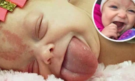 Paisley Morrison-Johnson bị mắc Hội chứng hiếm gặp Wiedemann Beckwith với cái lưỡi gấp đôi bình thường