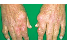 Viêm đa khớp dạng thấp