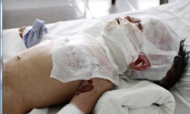 Bé 10 tháng tuổi ngã vào nồi cơm đang sôi