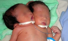 Một bé gái sơ sinh có hai đầu, ba tay