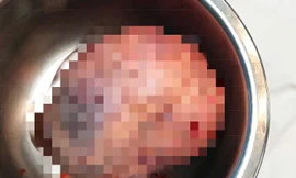 Cứu sống người phụ nữ 30 năm sống cùng khối u khổng lồ