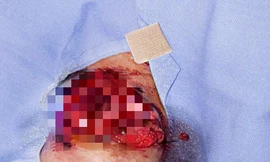 Bé gái 13 tuổi gần đứt lìa tay vì pháo nổ văng trúng