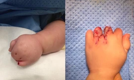 Bác sĩ Việt ‘hóa phép’ cho bệnh nhi bị dính ngón bẩm sinh