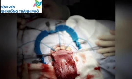 Bé trai 5 tuổi bụng phình to như bà bầu vì táo bón