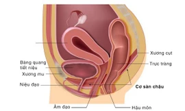 Gần 50% phụ nữ mắc chứng sa tạng chậu