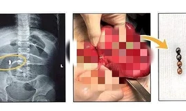 Hình ảnh 4 viên bi nam châm được gắp ra từ ruột bé gái