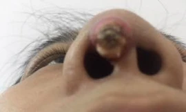 Nâng mũi tại tiệm cắt tóc, người phụ nữ lòi cả đầu sống mũi ra ngoài