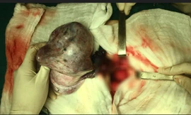 Bé gái 13 tuổi ngỡ mang bầu 6 tháng vì khối u buồng trứng khổng lồ