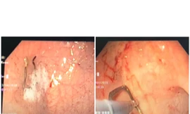 Nuốt móc sắt kẹp quần áo, bé trai 18 tháng suýt thủng ruột