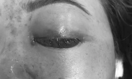 Khách bị mù mắt sau tiêm filler, chủ spa bị phạt 120 triệu đồng