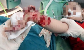 Người lớn lơ là, bé trai 3 tuổi bị máy xay thịt nghiền nát cánh tay