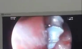 Gắp thành công đinh xoắn ốc ra khỏi dạ dày bé gái 2 tuổi