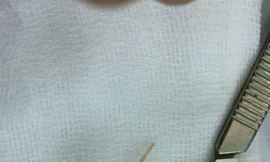 Bàng hoàng phát hiện tăm xỉa răng, xương cá trong bụng