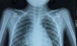 Ho ra máu liên tục, bé trai 11 tuổi suýt chết vì bệnh hiếm gặp