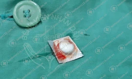 Phát hiện viên thuốc còn vỏ trong phế quản người đàn ông