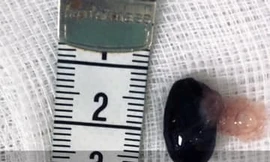 Cứu sống bé trai ngưng tim vì hóc hạt mãng cầu