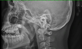 Vừa xem tivi vừa ăn, bé gái phải cấp cứu vì nuốt xương gà