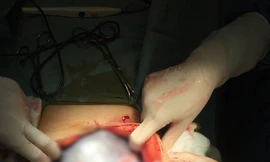 Hút 7 lít dịch từ khối u của người phụ nữ ngỡ mang thai 6 tháng