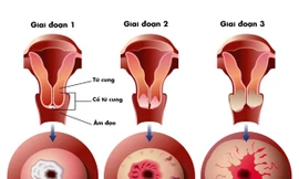 “Hiện thực hóa” ước mơ có con của bệnh nhân ung thư cổ tử cung