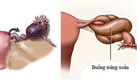 Bé gái 10 tuổi suýt mất buồng trứng vì khối u