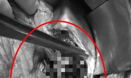 Cứu sống nam thanh niên đứt lìa gan vì tai nạn giao thông