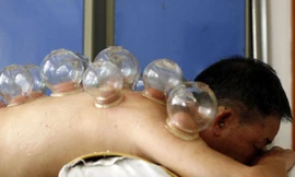 Giác hơi - không phải trò vui