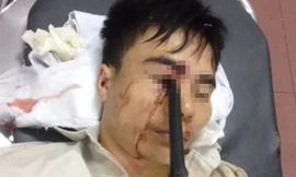 Cầm ô đi xe máy, thanh niên bị cán gương đâm xuyên mắt