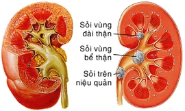 Sỏi thận - Ngăn ngừa tái phát trong điều trị