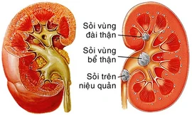 Sỏi thận - Ngăn ngừa tái phát trong điều trị