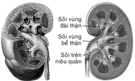 Sỏi thận - Ngăn ngừa tái phát trong điều trị