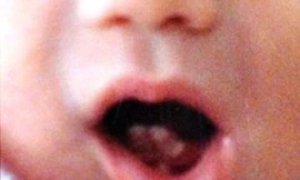 Bé gái mới sinh có hai răng cửa