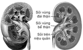 Sỏi thận - Ngăn ngừa tái phát trong điều trị