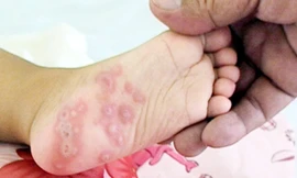Biểu hiện nốt phỏng ở lòng bàn chân trong bệnh tay chân miệng 
