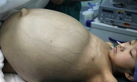 Khối u có kích thước lớn hơn hai quả bóng đá và nặng gần 15 kg. Ảnh: Getty Images.