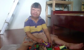 Nụ cười nhói lòng của bé trai bị bố đốt 3 năm trước