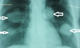 Kinh hãi hàng nghìn sán chó ở phổi bệnh nhân